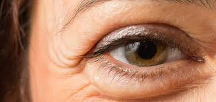 ترهل الجلد حول العين.. الأسباب والعلاج