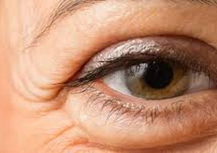 ترهل الجلد حول العين.. الأسباب والعلاج