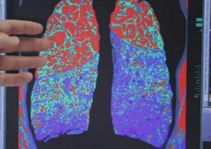 تجّمُع الماء في الرئة: الأسباب، الأعراض، العلاج!