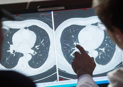 أغذية مقاومة للسرطان.. 10 أطعمة تحمي من المرض "القاتل"