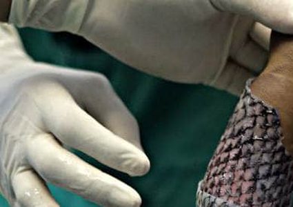 دراسة : جلد السمك الوسيلة الأكثر "فعالية" لعلاج الحروق