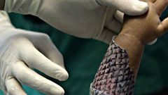 دراسة : جلد السمك الوسيلة الأكثر "فعالية" لعلاج الحروق