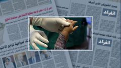 تعرف على الطريقة الجديدة لعلاج الحروق ب "جلد السمك"