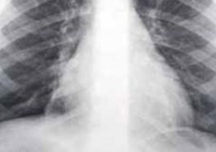 الكشف المبكر للالتهاب الرئوي عند الاطفال