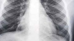 الكشف المبكر للالتهاب الرئوي عند الاطفال