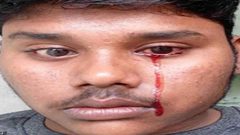 شاب يبكي دما.. ونتائج فحوصاته تحير الأطباء