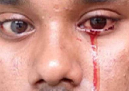 شاب يبكي دما.. ونتائج فحوصاته تحير الأطباء