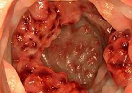 4 أعراض للإصابة بسرطان الأمعاء