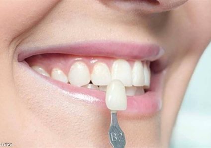 عدسات الأسنان اللاصقة.. حل تجميلي بتكلفة باهظة