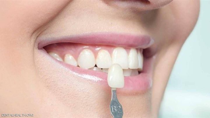 عدسات الأسنان اللاصقة.. حل تجميلي بتكلفة باهظة