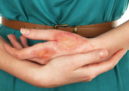 3 خلطات إزالة آثار الحروق القديمة