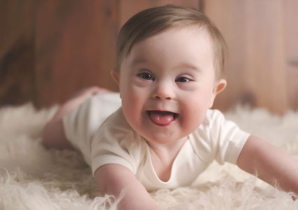 متلازمة داون: الأعراض والأنواع والعلاج