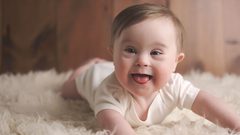متلازمة داون: الأعراض والأنواع والعلاج