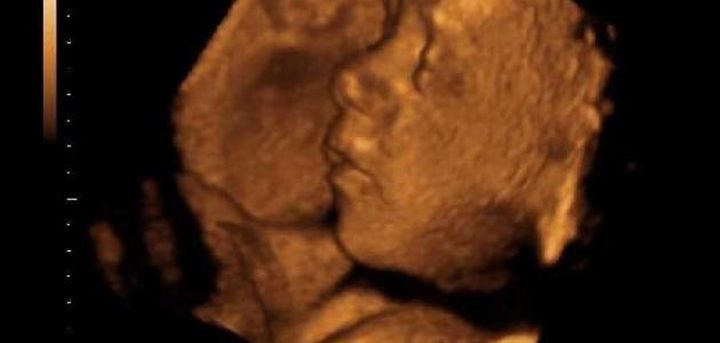 تشوهات الجنين: الأسباب، الأنواع،العوامل، الوقاية!