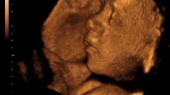 تشوهات الجنين: الأسباب، الأنواع،العوامل، الوقاية!