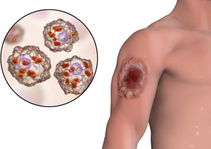 ما هو مرض اللشمانيا؟