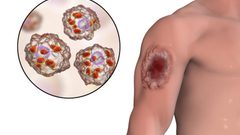 ما هو مرض اللشمانيا؟