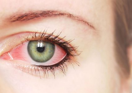 ظهور بقع دم في العين: الأسباب، طرق العلاج!