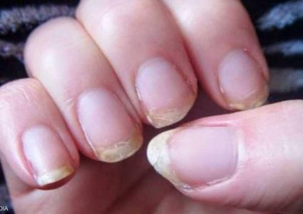 أظافرك وصحتك.. 8 علامات خطيرة "لا تتجاهلها أبدا"
