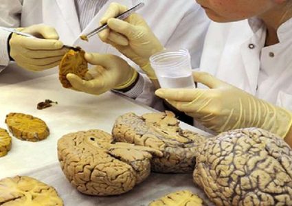 علاقة خطرة بين السمنة وشيخوخة الدماغ المبكرة