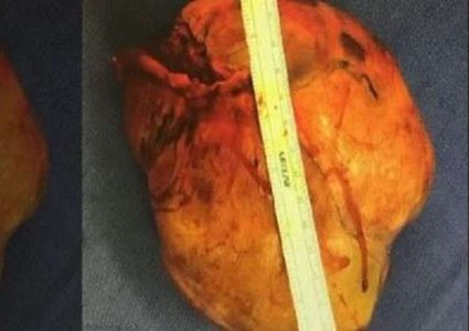 مرض نادر يضع امرأة على حافة الجنون