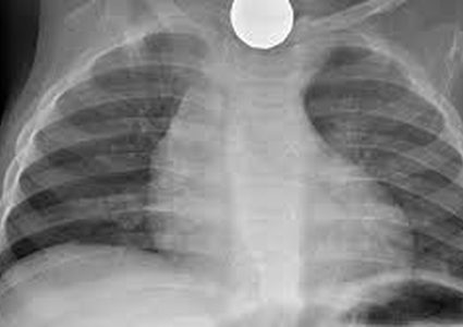 بسبب دعابة من أصدقائه ابتلع قطعتين نقديتين