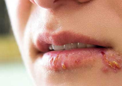 ما علاقة السرطان بفيروس الهربس؟