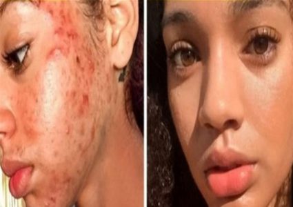 عارضة أزياء تكشف سر قضائها على "حَب الشباب" في شهر