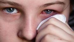 6 وصفات طبيعية لعلاج حساسية العين