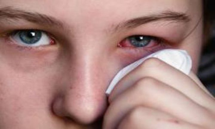 6 وصفات طبيعية لعلاج حساسية العين