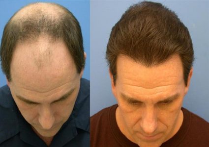 معلومات مهمة عن عملية زراعة الشعر