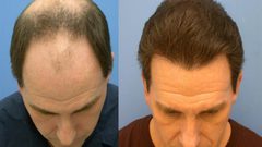 معلومات مهمة عن عملية زراعة الشعر