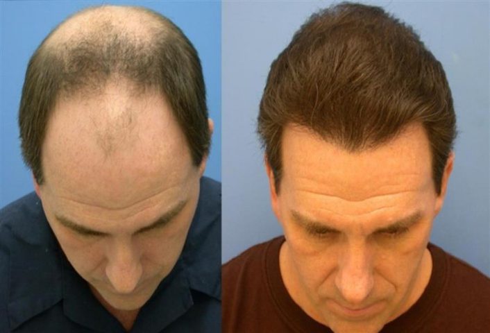 معلومات مهمة عن عملية زراعة الشعر