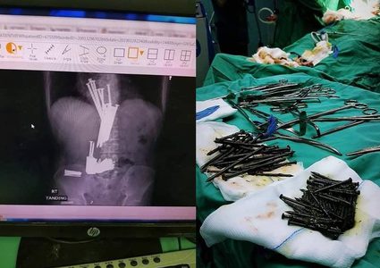 اطباء يستخرجون مسامير من بطن مريض في جنين
