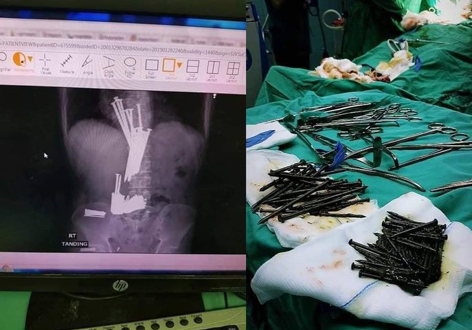 اطباء يستخرجون مسامير من بطن مريض في جنين