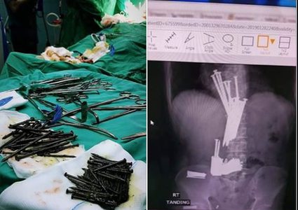 مدير مستشفى جنين يوضح تفاصيل العثور على مسامير داخل بطن مريض