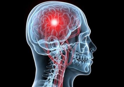 أعراض الجلطة الدماغية تهدد الرجال تحت الـ 75 عامًا