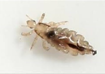 أطباء يعثرون على حشرة حية تعيش داخل جبهة امرأة بريطانية!