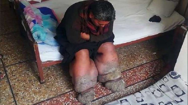 رجل باكستاني يصاب بداء الفيل بسبب لسعة بعوضة !