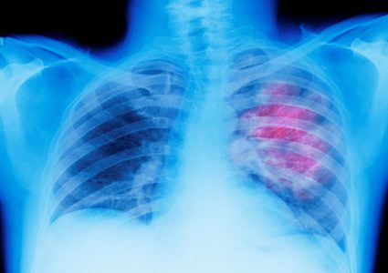 احذروا.. تناول هذه الأطعمة تسبب سرطان الرئة !