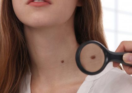 طرق التعرف على الشامة السرطانية وتمييزها