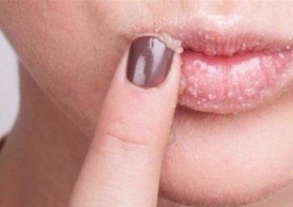 وصفة منزلية لمواجهة تشقق الشفاه في الشتاء