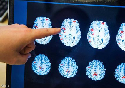 دماغ الرجل أم المرأة.. دراسة تكشف "الفارق المذهل"