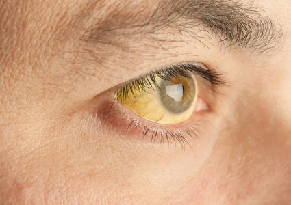 "القاتل الصامت" :العلامات الأولية للإصابة بسرطان البنكرياس