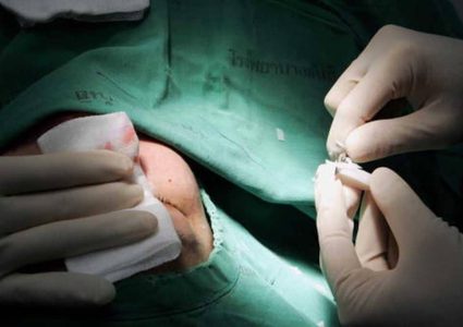 عمليات تجميل الأنف.. معلومات ومخاطر