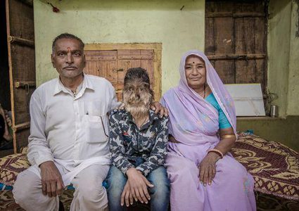 الطفل المستذئب في الهند!