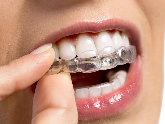 ما هي قوالب تبييض الاسنان ؟