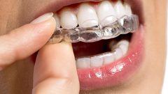 ما هي قوالب تبييض الاسنان ؟