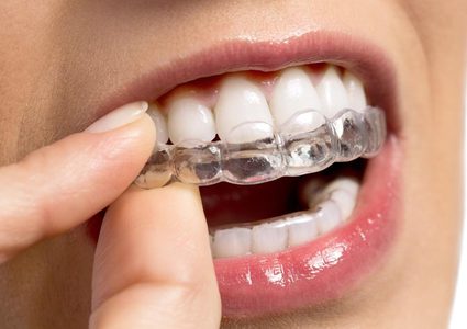 ما هي قوالب تبييض الاسنان ؟