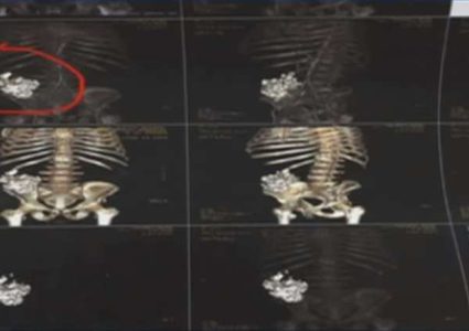 استخراج أجسام غريبة من أمعاء مواطن مصري في الصعيد